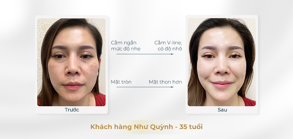 Trước và sau khi tiêm chất làm đầy