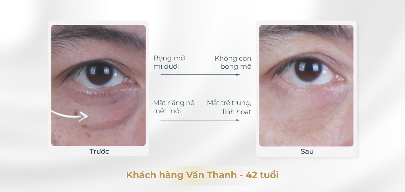 Kết quả trước và sau khi lấy mỡ bọng mắt