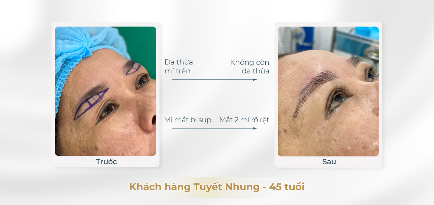 Kết quả trước và sau khi cắt da thừa mí trên