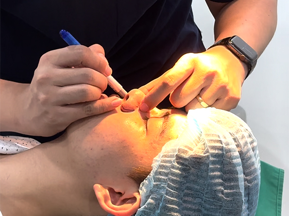Giới thiệu dịch vụ thu gọn cánh mũi