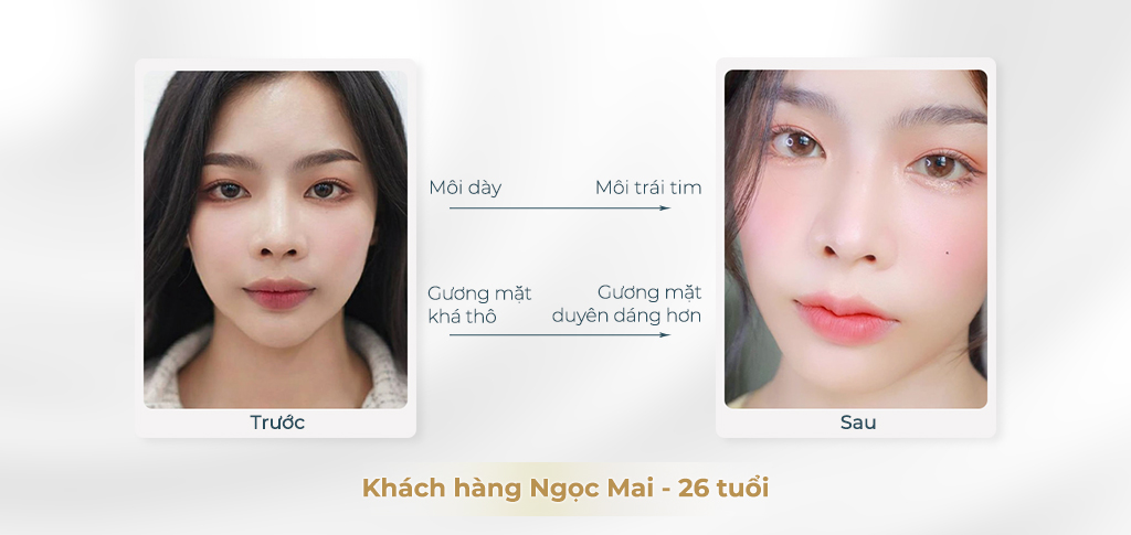 Kết quả thu gọn môi dày