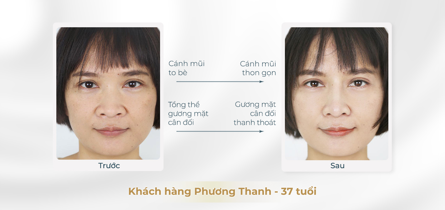 Trước và sau khi thu gọn cánh mũi