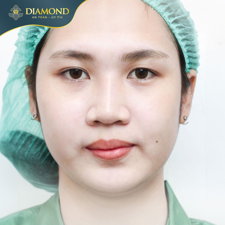 Cánh mũi to, bè rộng ra hai bên khiến gương mặt không được hài hòa, thon gọn