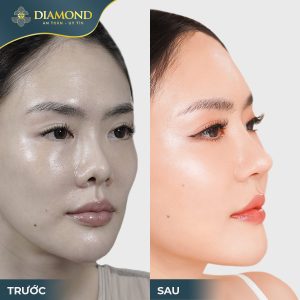 Dáng mũi xấu khiến nhan sắc bị “dìm”, gương mặt không có điểm nhấn
