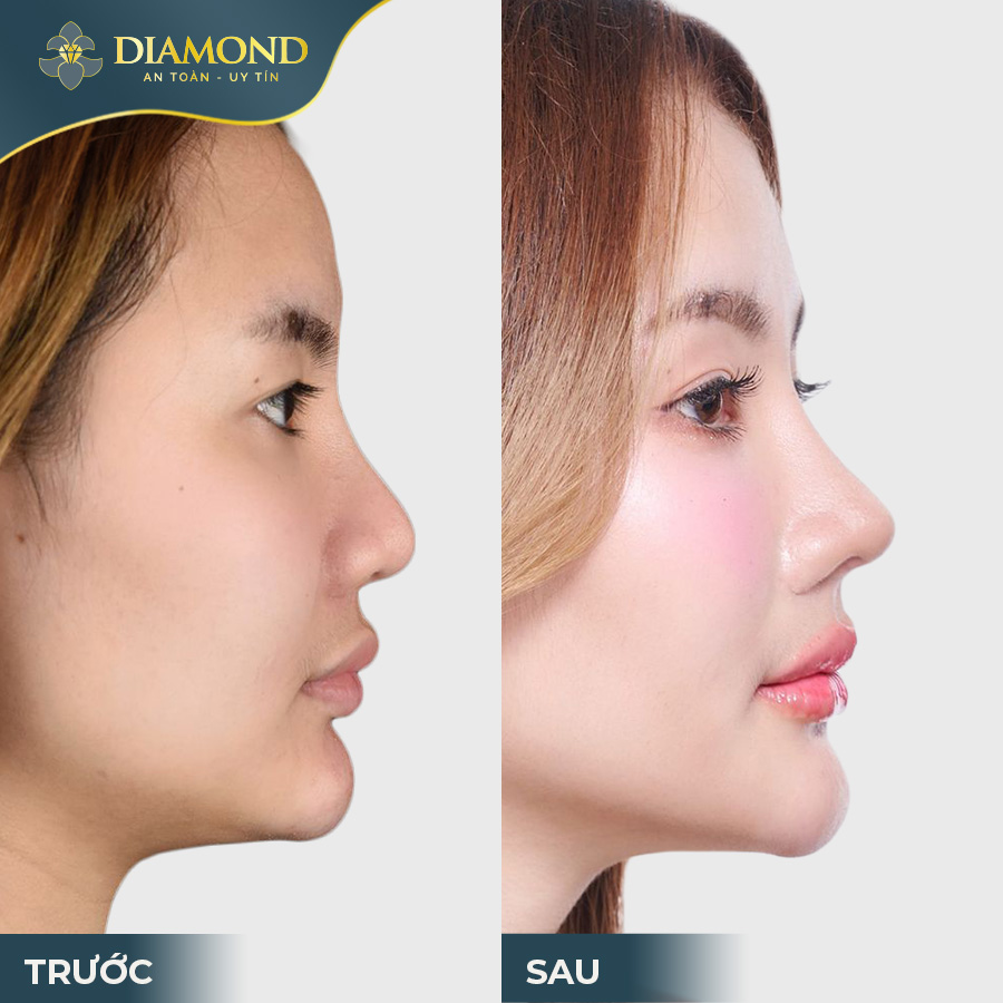 Nhan sắc thăng hạng sau khi nâng mũi cấu trúc
