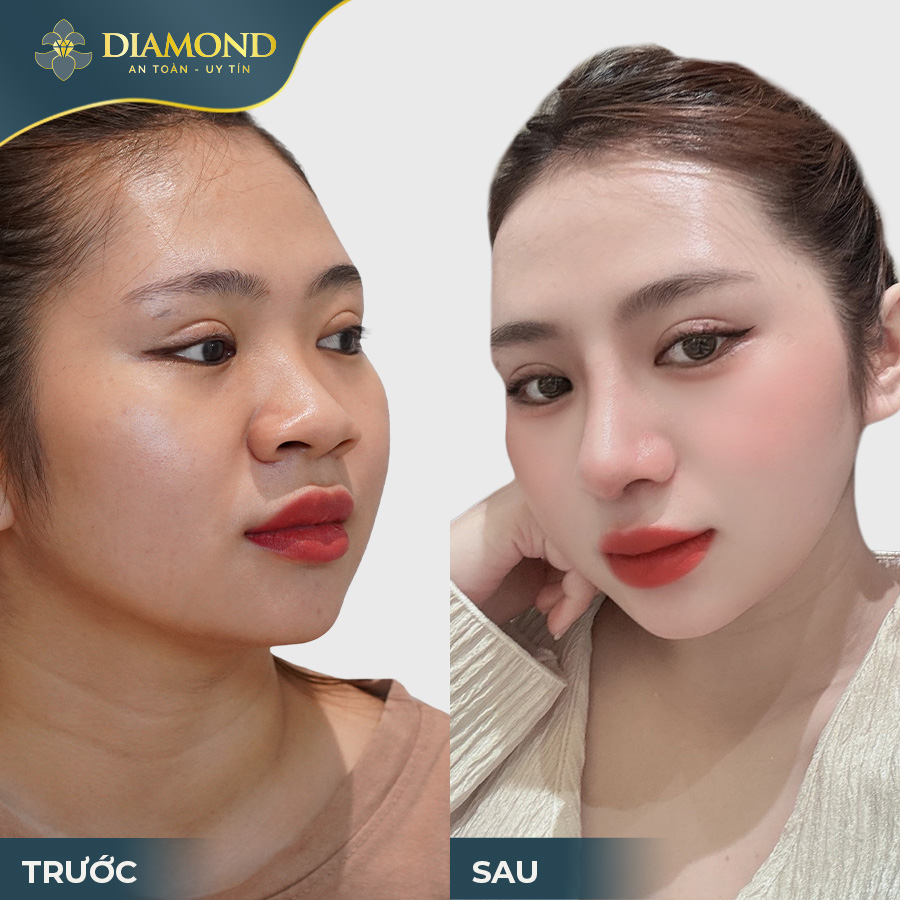 Nâng mũi đẹp, an toàn và làm hài lòng khách hàng là mục tiêu của Phẫu Thuật Thẩm Mỹ Diamond