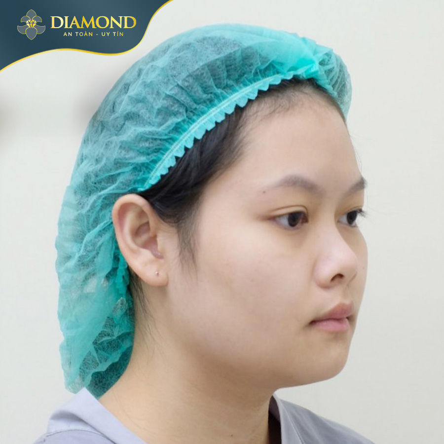 Sống mũi thấp tẹt, đầu mũi to tròn khiến tổng thể dáng mũi trông không sắc nét