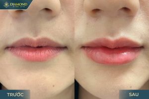 Kết quả tiêm filler môi
