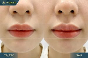 Kết quả tiêm filler môi