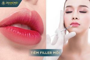 Tiêm filler môi