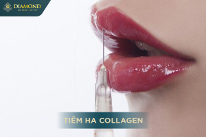 Tiêm môi HA Collagen