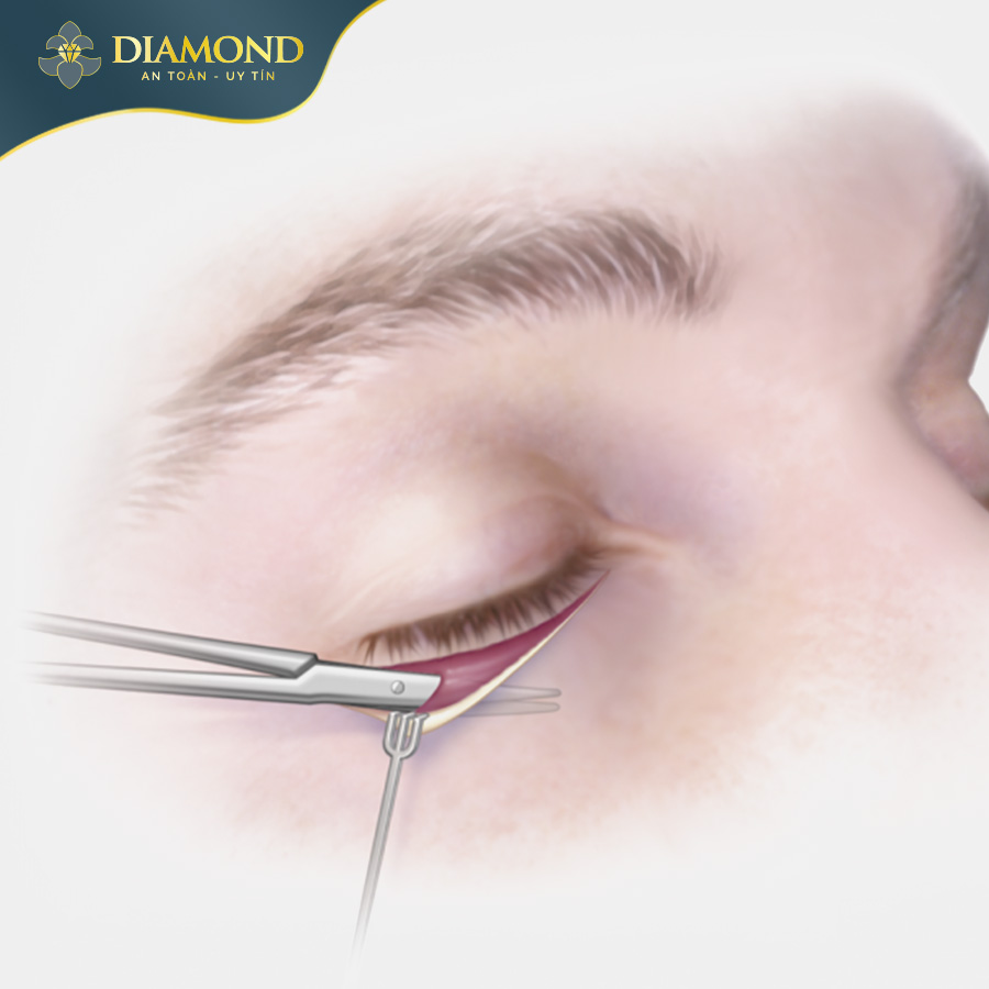 Da thừa có thể được khắc phục bằng cách cắt bỏ phần da dư để làm căng da, giúp mi dưới trông mịn màng hơn