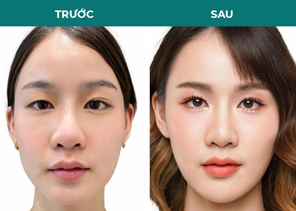khách hàng trước sau cắt mí