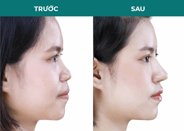 khách hàng trước sau nâng mũi
