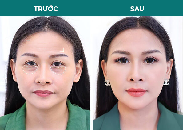 khách hàng trước sau lấy mỡ bọng mắt